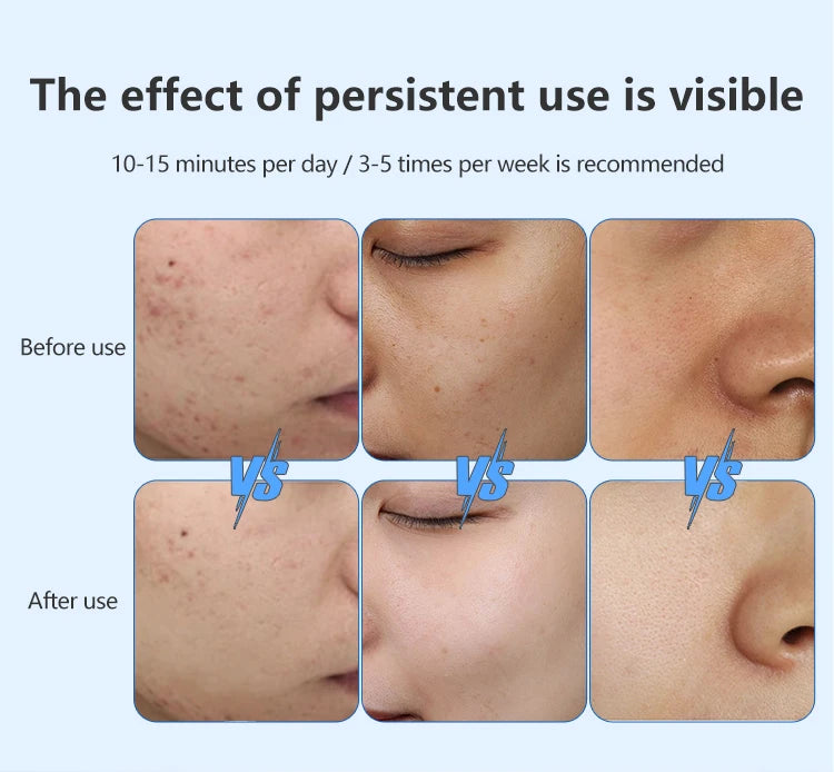 Comparativo de pele antes e depois do uso da máscara facial LED